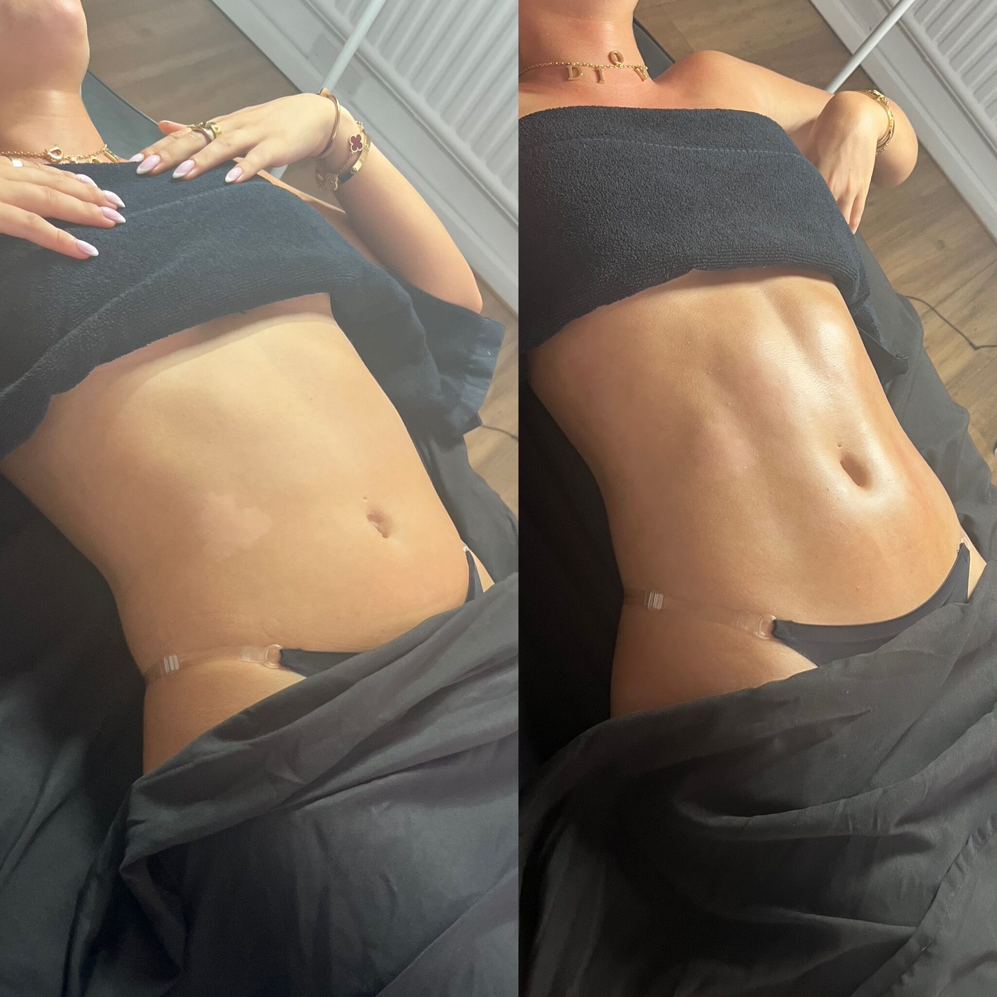 Before & after – lymphatic drainage